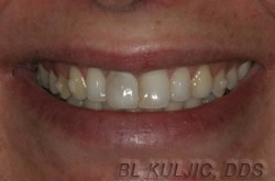 Before whitening, bonding and all-ceramic crowns